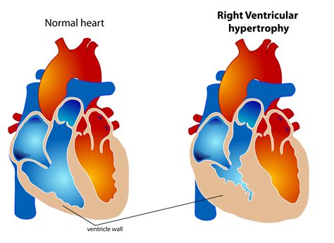 right ventricular hypertrophy measurements